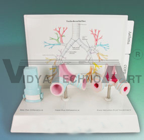 Asthma Model